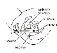 Cleocin Suppository Cost